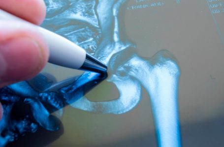 La viscosupplementazione ecoguidata nella coxartrosi di pazienti con comorbilità